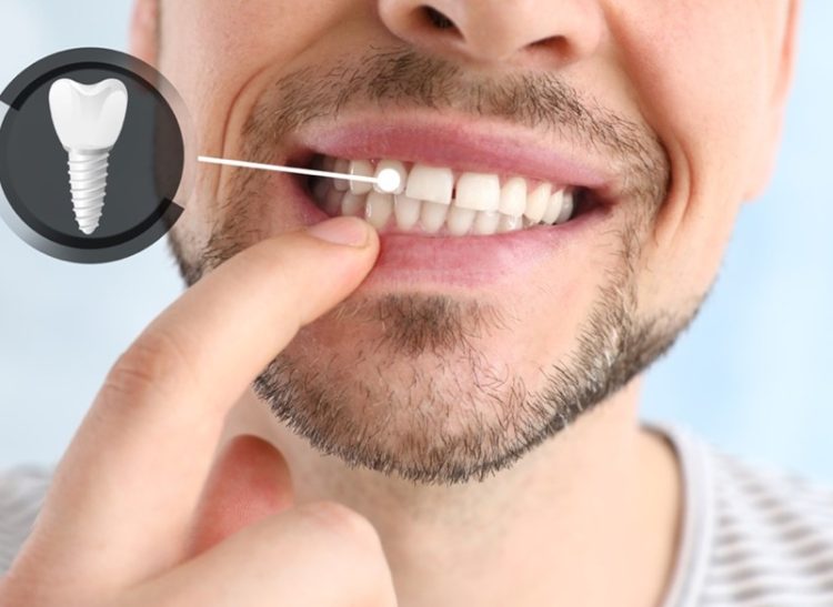 implant-dentaire-pour-la-vie